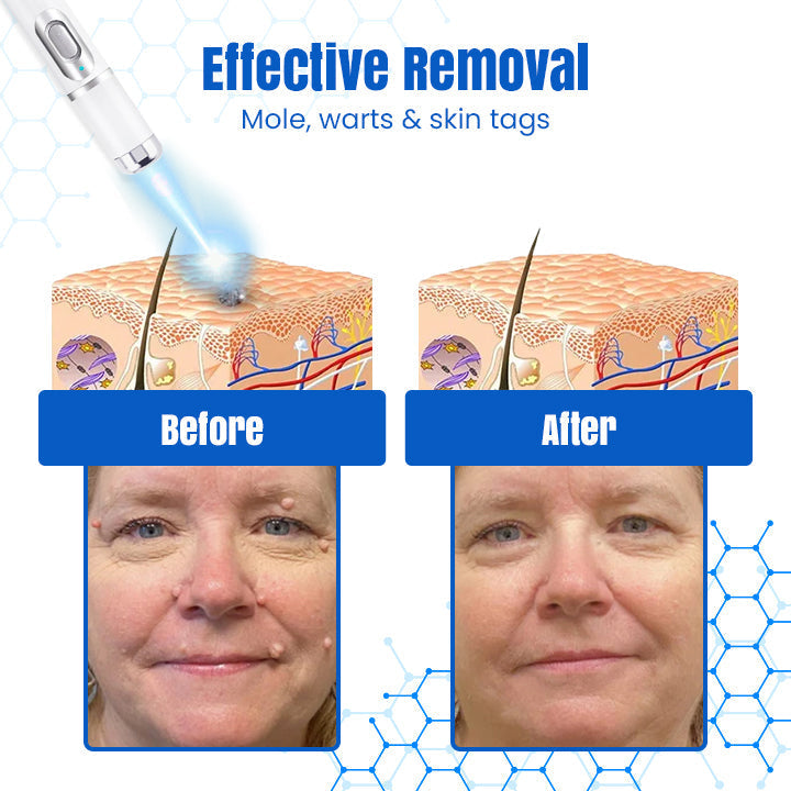 Bikenda® DermZap Mole & Wart Removal Laser Pen