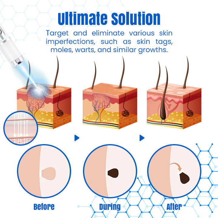 Bikenda® DermZap Mole & Wart Removal Laser Pen