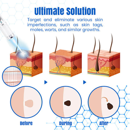 Bikenda® DermZap Mole & Wart Removal Laser Pen