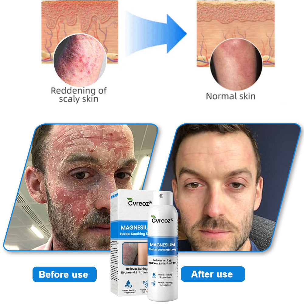 ✅  Official Store:KUBOZN® Magnesium Herbal Spray – Fast Relief for Psoriasis & Eczema | No-Rub, Steroid-Free (OFFER)