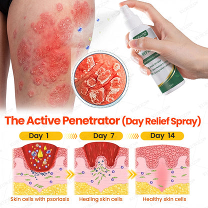 KUBOZN® Psoriasis Day & Night Repair System - 100% Steroid-Free Relief Duo for Plaques, Scaling & Itch