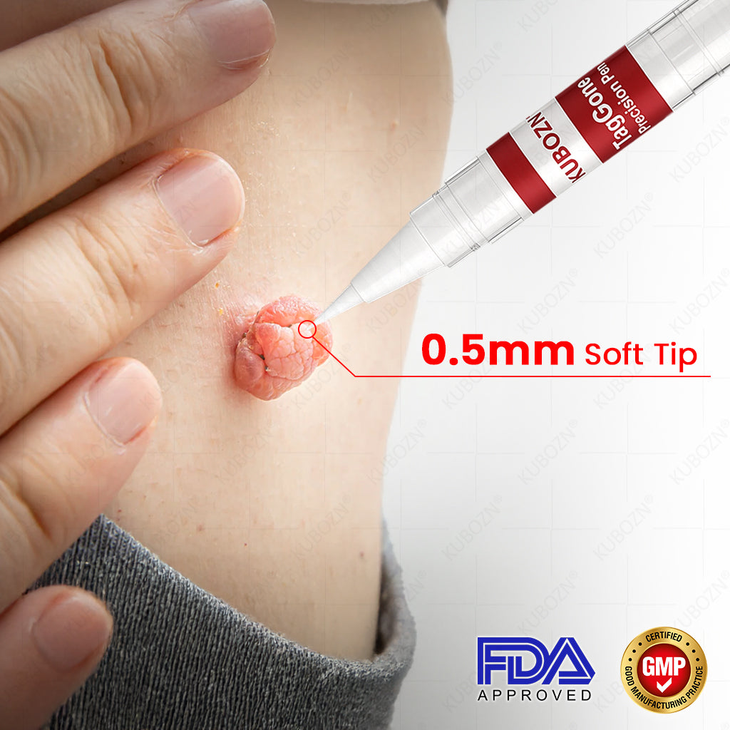 ✨KUBOZN® TagGone Precision Pen (2025 Upgrade) | Skin Tag, Mole & Wart Remover – Fast, Gentle & Scar-Free in 5 Days 🅱︎